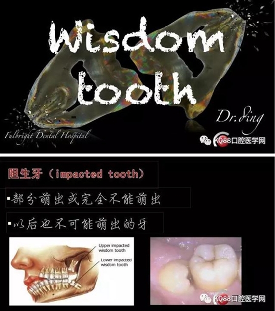 智齒拔除 智齒拔除