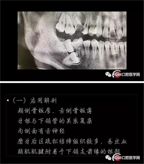 智齒拔除 智齒拔除