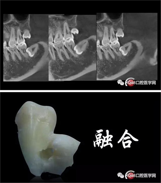 智齒拔除 智齒拔除