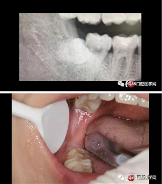 智齒拔除 智齒拔除