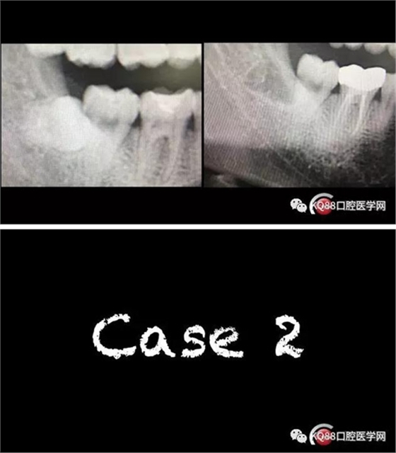 智齒拔除 智齒拔除