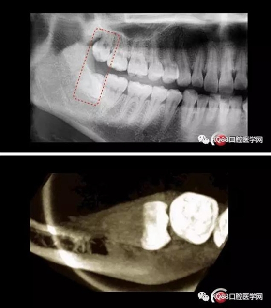 智齒拔除 智齒拔除