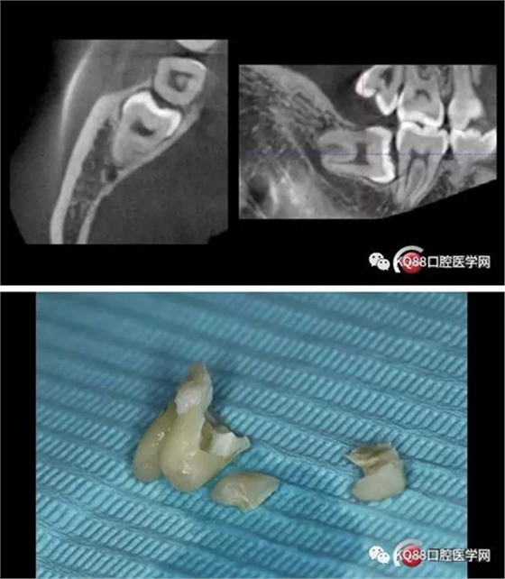 智齒拔除 智齒拔除