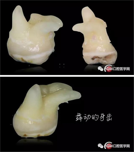 智齒拔除 智齒拔除