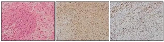 下頜反復(fù)溢膿，是何原因？  