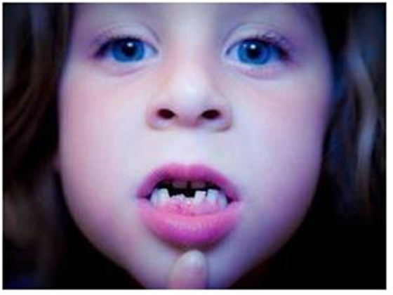 口腔血管瘤 口腔血管瘤