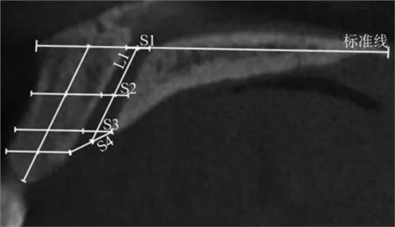 正常人群上頜前牙區(qū)鼻腭管相關解剖結構的錐形束CT研究