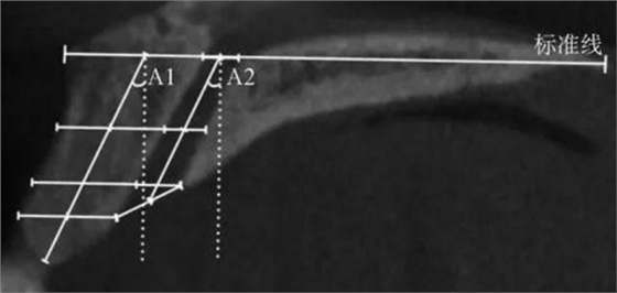 正常人群上頜前牙區(qū)鼻腭管相關解剖結構的錐形束CT研究