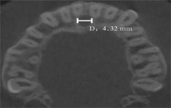 正常人群上頜前牙區(qū)鼻腭管相關解剖結構的錐形束CT研究