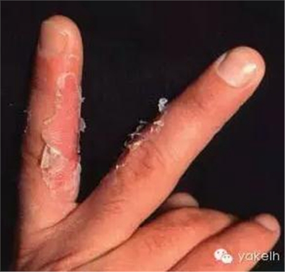 正畸中與材料相關(guān)的副作用---樹脂基材料的過敏反應 正畸中與材料相關(guān)的副作用---樹脂基材料的過敏反應