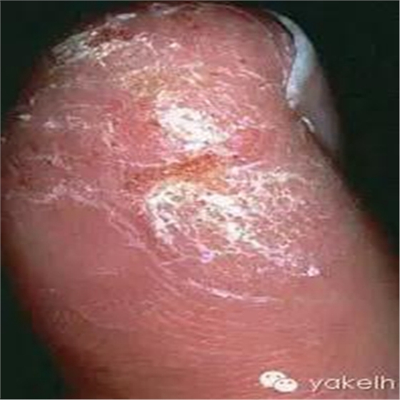 正畸中與材料相關(guān)的副作用---樹脂基材料的過敏反應 正畸中與材料相關(guān)的副作用---樹脂基材料的過敏反應