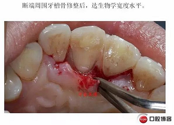 前牙外傷冠延長+全瓷冠修復(fù)