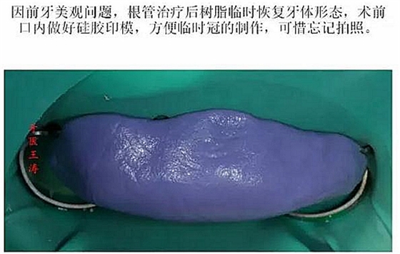 前牙外傷冠延長+全瓷冠修復(fù)