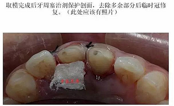 前牙外傷冠延長+全瓷冠修復(fù)