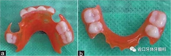 【牙醫(yī)學(xué)堂】間隙保持器的介紹 【牙醫(yī)學(xué)堂】間隙保持器的介紹