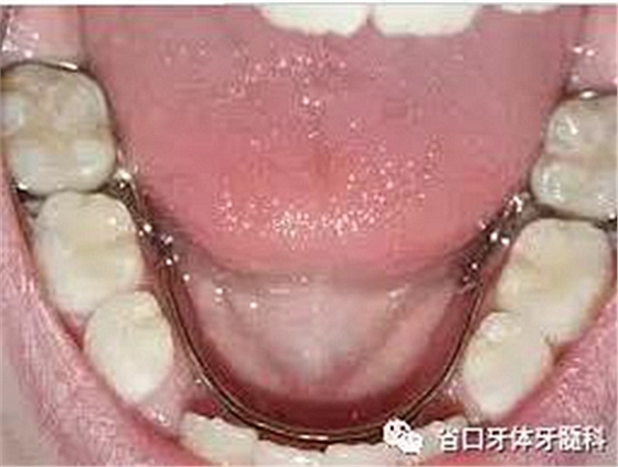 【牙醫(yī)學(xué)堂】間隙保持器的介紹 【牙醫(yī)學(xué)堂】間隙保持器的介紹