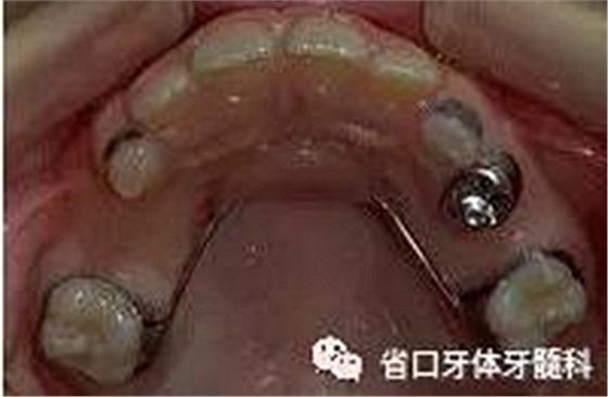 【牙醫(yī)學(xué)堂】間隙保持器的介紹 【牙醫(yī)學(xué)堂】間隙保持器的介紹