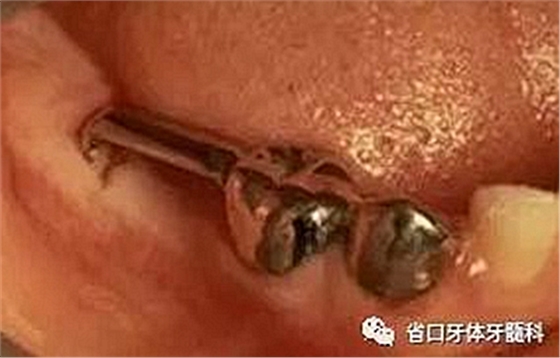 【牙醫(yī)學(xué)堂】間隙保持器的介紹 【牙醫(yī)學(xué)堂】間隙保持器的介紹