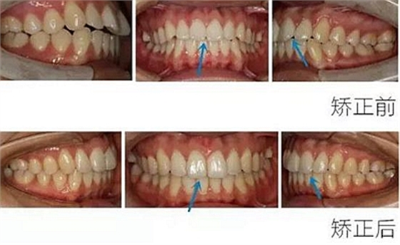醫(yī)生方案里的鄰面去釉，究竟是什么？