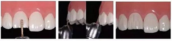 前牙全瓷冠牙體預備步驟   