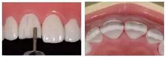 前牙全瓷冠牙體預備步驟   