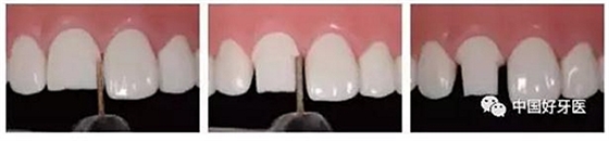 前牙全瓷冠牙體預備步驟   