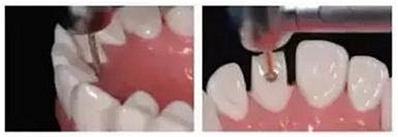 前牙全瓷冠牙體預備步驟   