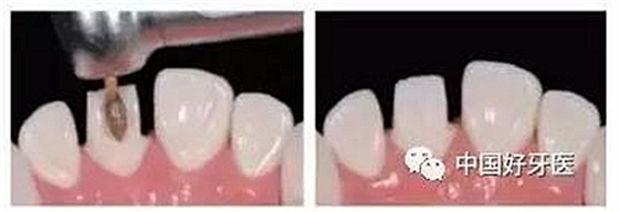 前牙全瓷冠牙體預備步驟   