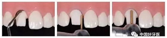 前牙全瓷冠牙體預備步驟   