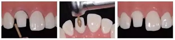 前牙全瓷冠牙體預備步驟   