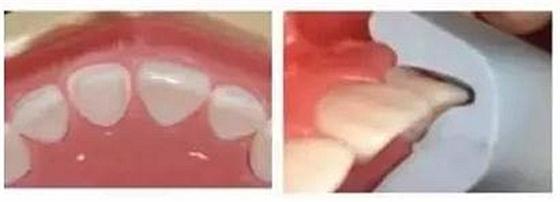 前牙全瓷冠牙體預備步驟   