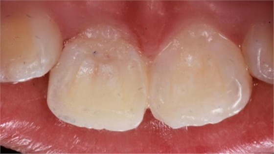 劉勇:斷牙再粘結(jié)兩例病例 劉勇:斷牙再粘結(jié)兩例病例