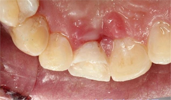 劉勇:斷牙再粘結(jié)兩例病例 劉勇:斷牙再粘結(jié)兩例病例
