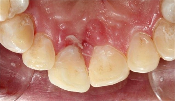 劉勇:斷牙再粘結(jié)兩例病例 劉勇:斷牙再粘結(jié)兩例病例