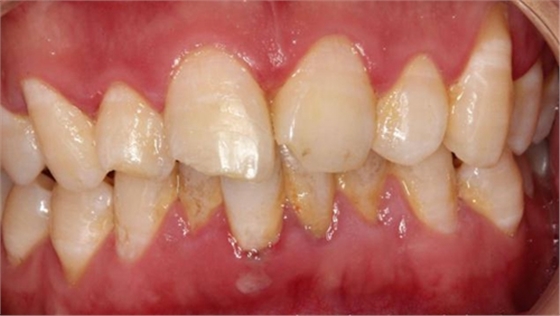 劉勇:斷牙再粘結(jié)兩例病例 劉勇:斷牙再粘結(jié)兩例病例