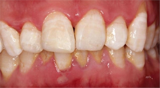 劉勇:斷牙再粘結(jié)兩例病例 劉勇:斷牙再粘結(jié)兩例病例