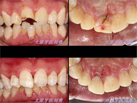 劉勇:斷牙再粘結(jié)兩例病例 劉勇:斷牙再粘結(jié)兩例病例