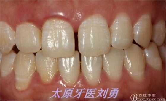 劉勇:斷牙再粘結(jié)兩例病例 劉勇:斷牙再粘結(jié)兩例病例