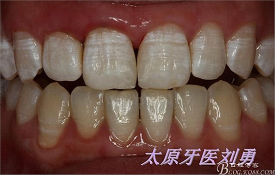 劉勇:斷牙再粘結(jié)兩例病例 劉勇:斷牙再粘結(jié)兩例病例