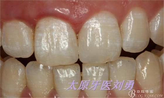 劉勇:斷牙再粘結(jié)兩例病例 劉勇:斷牙再粘結(jié)兩例病例