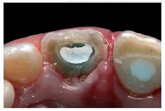 牙體大面積缺損:根管治療后行纖維樁—樹脂修復(fù) 牙體大面積缺損:根管治療后行纖維樁—樹脂修復(fù)