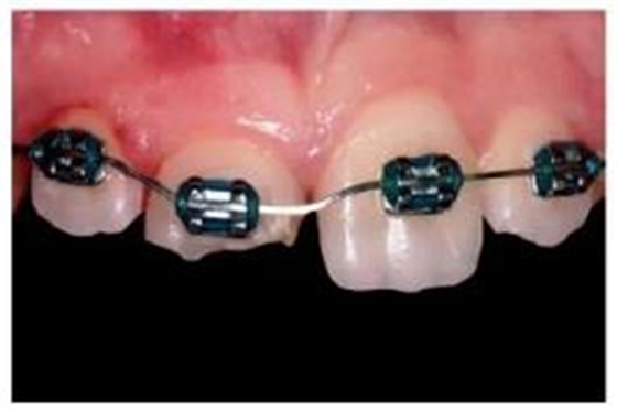 牙體大面積缺損:根管治療后行纖維樁—樹脂修復(fù) 牙體大面積缺損:根管治療后行纖維樁—樹脂修復(fù)