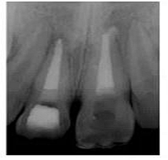 牙體大面積缺損:根管治療后行纖維樁—樹脂修復(fù) 牙體大面積缺損:根管治療后行纖維樁—樹脂修復(fù)