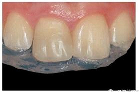 牙體大面積缺損:根管治療后行纖維樁—樹脂修復(fù) 牙體大面積缺損:根管治療后行纖維樁—樹脂修復(fù)