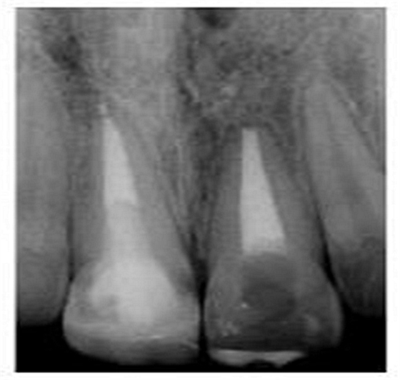 牙體大面積缺損:根管治療后行纖維樁—樹脂修復(fù) 牙體大面積缺損:根管治療后行纖維樁—樹脂修復(fù)