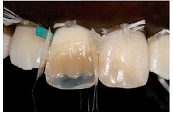 牙體大面積缺損:根管治療后行纖維樁—樹脂修復(fù) 牙體大面積缺損:根管治療后行纖維樁—樹脂修復(fù)