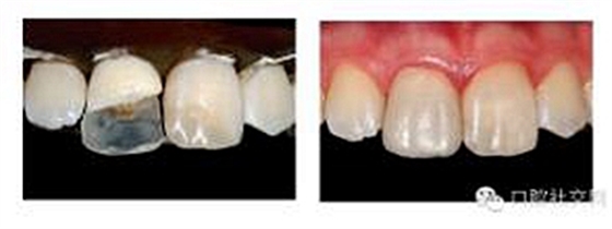 牙體大面積缺損:根管治療后行纖維樁—樹脂修復(fù) 牙體大面積缺損:根管治療后行纖維樁—樹脂修復(fù)