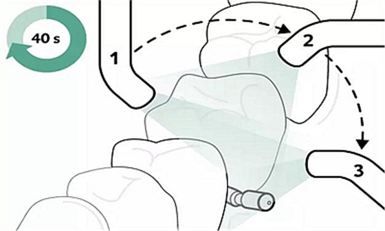 Icon 愛康滲透樹脂使用說明書 Icon 愛康滲透樹脂使用說明書