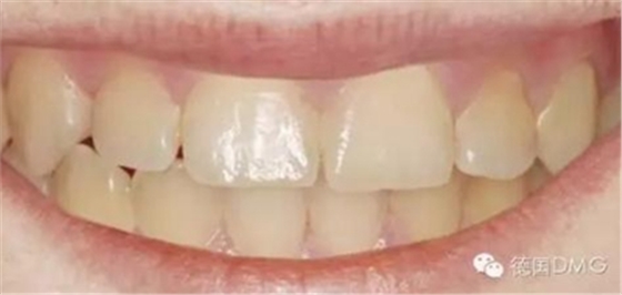 Icon 愛康滲透樹脂使用說明書 Icon 愛康滲透樹脂使用說明書