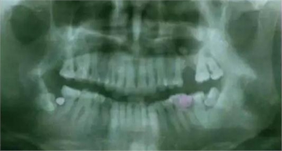 拔牙斷根的去與留？